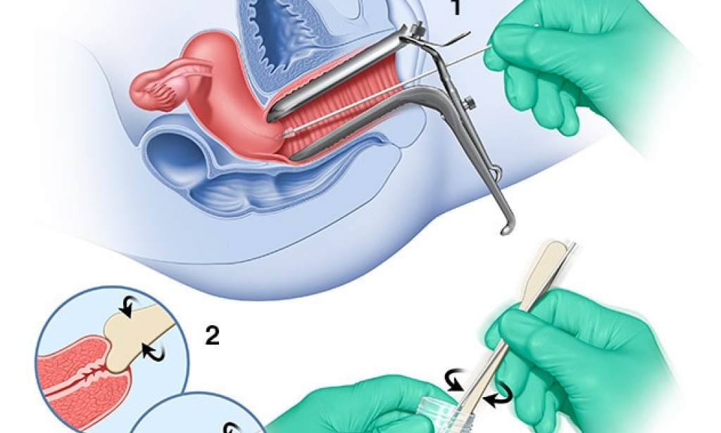 Pap Smears (Information)