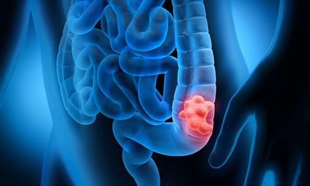 Dangers of colon cancer in males and females