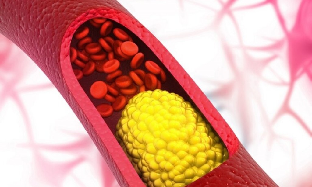 What habits should you give up if you have high cholesterol?